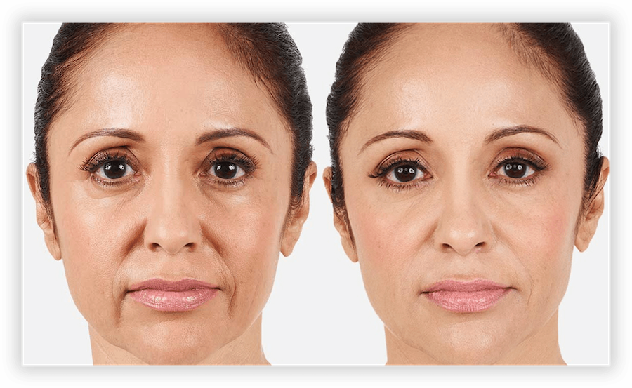 Non Surgical Facelift 2